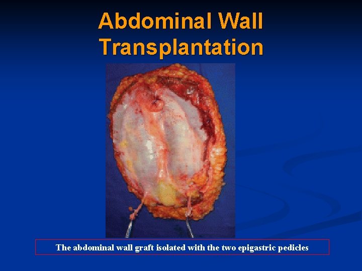 Abdominal Wall Transplantation The abdominal wall graft isolated with the two epigastric pedicles 