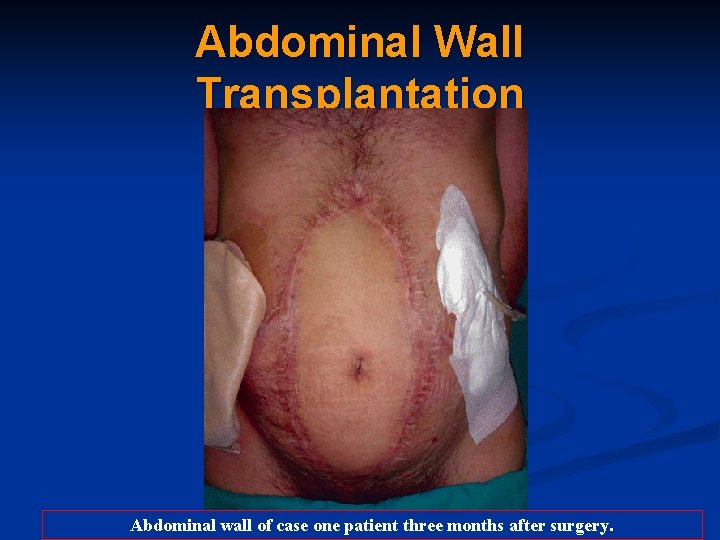 Abdominal Wall Transplantation Abdominal wall of case one patient three months after surgery. 