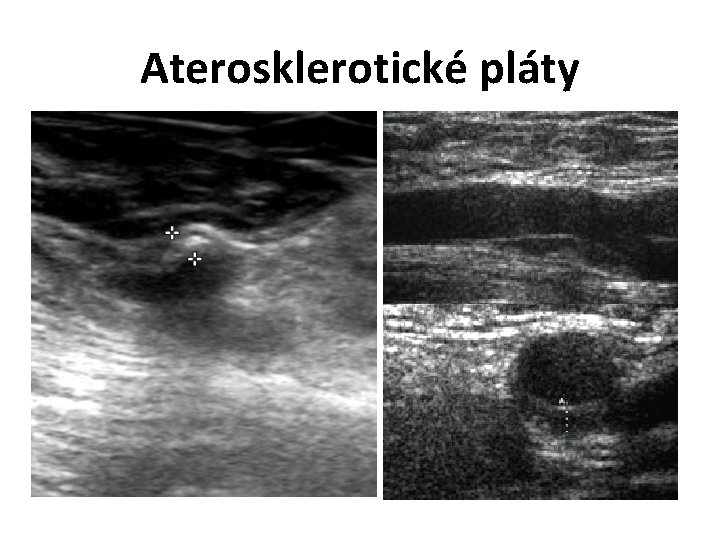 Aterosklerotické pláty 