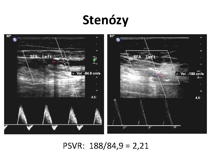 Stenózy PSVR: 188/84, 9 = 2, 21 