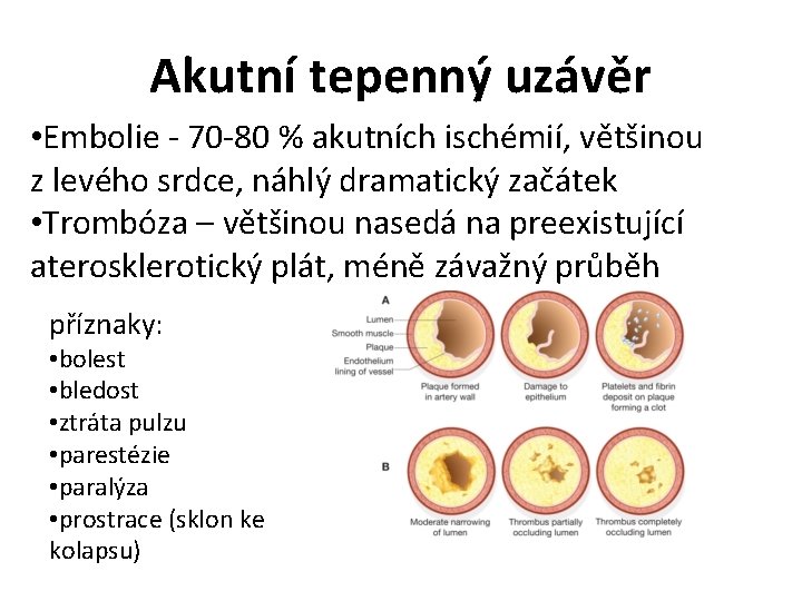 Akutní tepenný uzávěr • Embolie - 70 -80 % akutních ischémií, většinou z levého