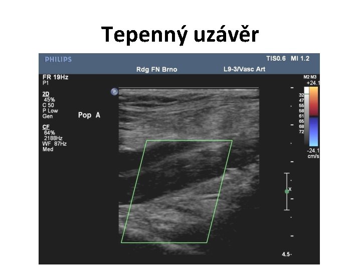 Tepenný uzávěr 