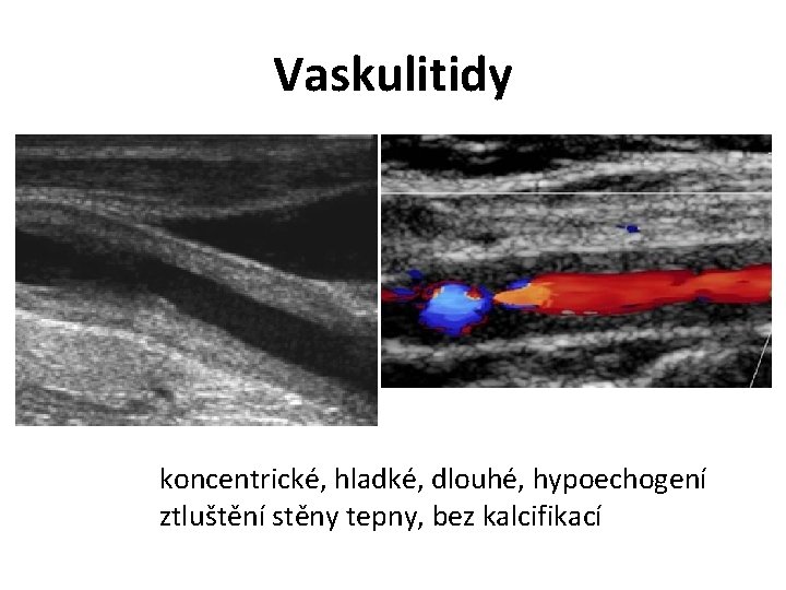 Vaskulitidy koncentrické, hladké, dlouhé, hypoechogení ztluštění stěny tepny, bez kalcifikací 