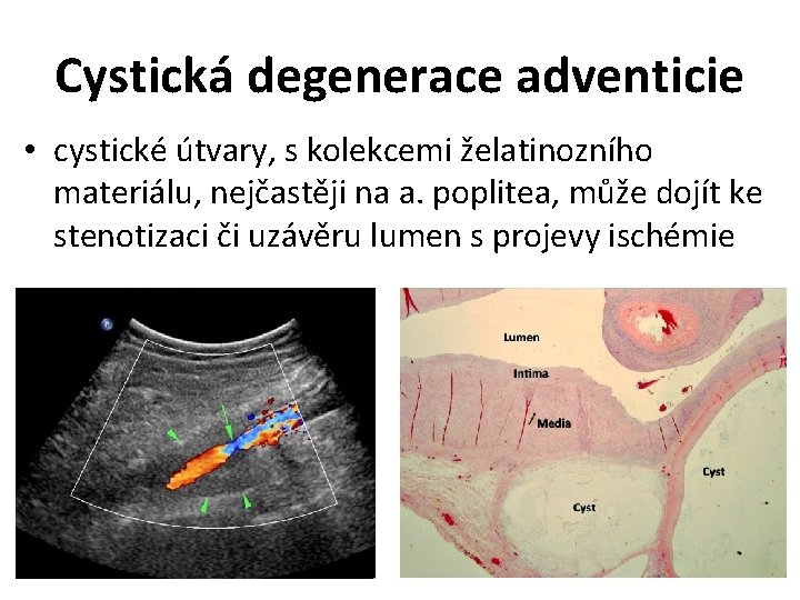 Cystická degenerace adventicie • cystické útvary, s kolekcemi želatinozního materiálu, nejčastěji na a. poplitea,