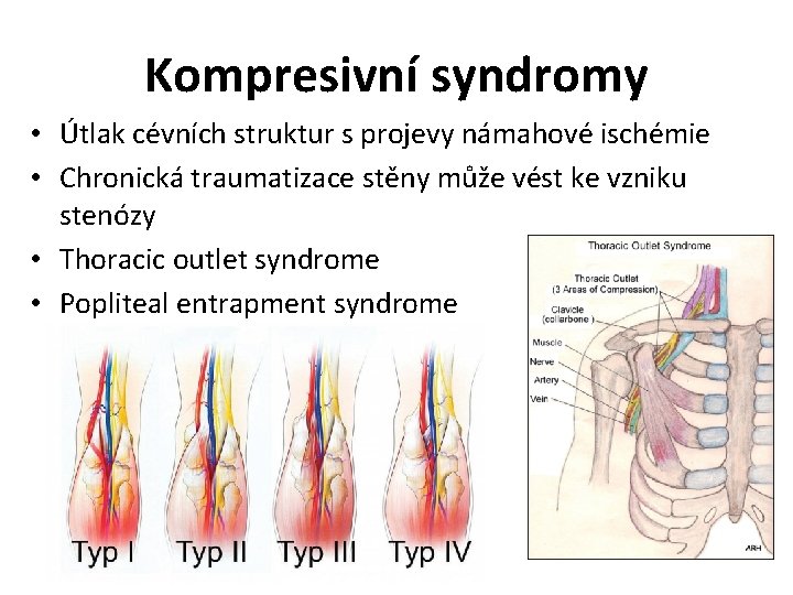 Kompresivní syndromy • Útlak cévních struktur s projevy námahové ischémie • Chronická traumatizace stěny