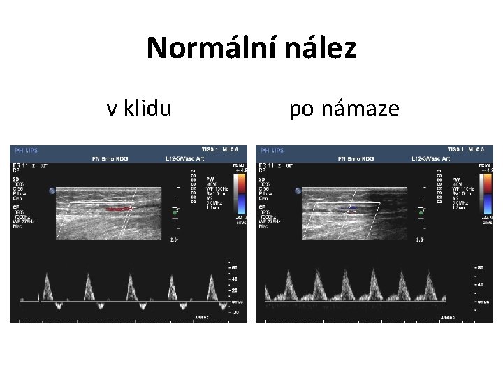 Normální nález v klidu po námaze 