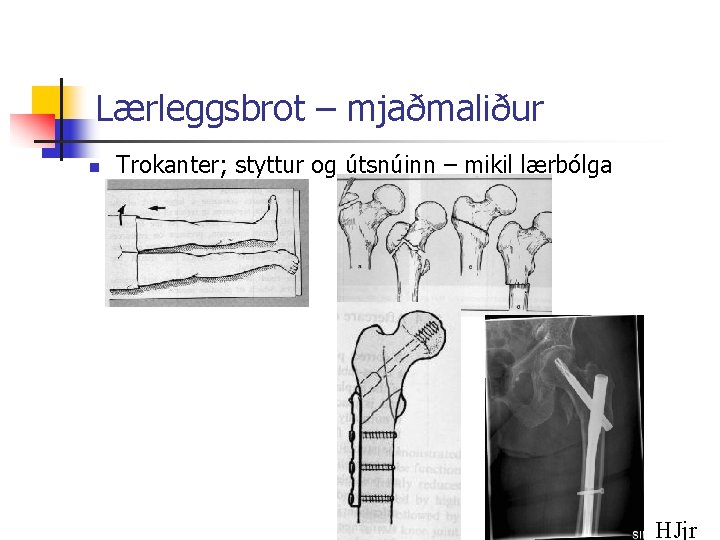 Lærleggsbrot – mjaðmaliður n Trokanter; styttur og útsnúinn – mikil lærbólga HJjr 