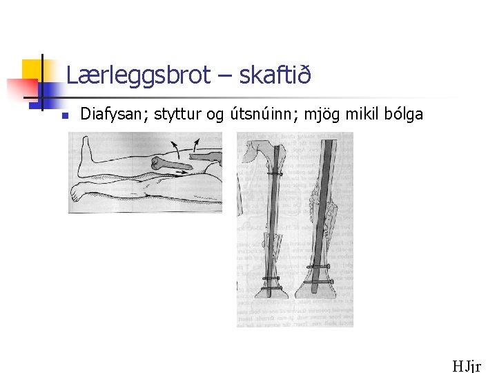 Lærleggsbrot – skaftið n Diafysan; styttur og útsnúinn; mjög mikil bólga HJjr 