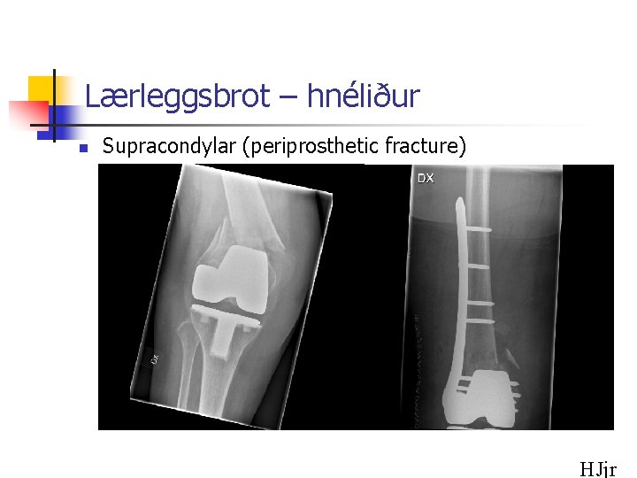 Lærleggsbrot – hnéliður n Supracondylar (periprosthetic fracture) HJjr 