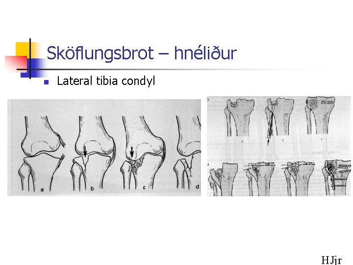 Sköflungsbrot – hnéliður n Lateral tibia condyl HJjr 