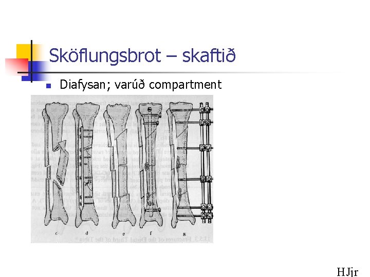 Sköflungsbrot – skaftið n Diafysan; varúð compartment HJjr 