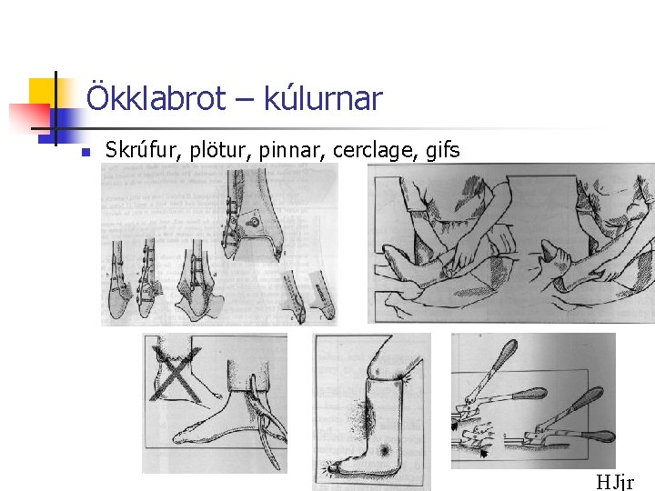 Ökklabrot – kúlurnar n Skrúfur, plötur, pinnar, cerclage, gifs HJjr 