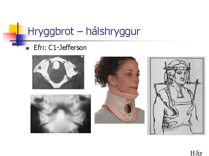 Hryggbrot – hálshryggur n Efri: C 1 -Jefferson HJjr 