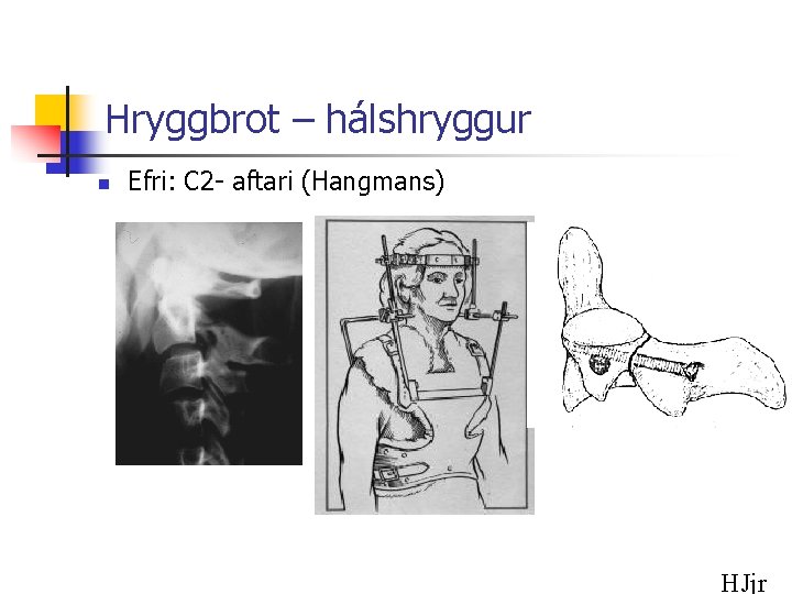 Hryggbrot – hálshryggur n Efri: C 2 - aftari (Hangmans) HJjr 