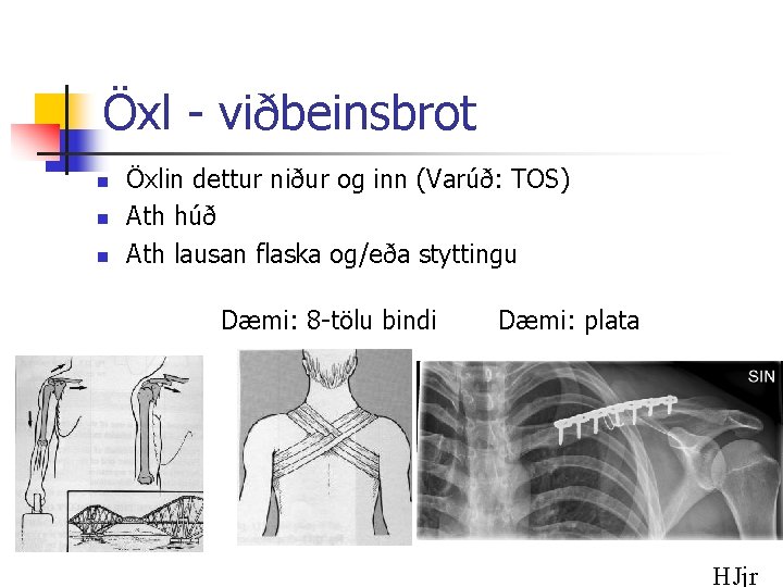 Öxl - viðbeinsbrot n n n Öxlin dettur niður og inn (Varúð: TOS) Ath