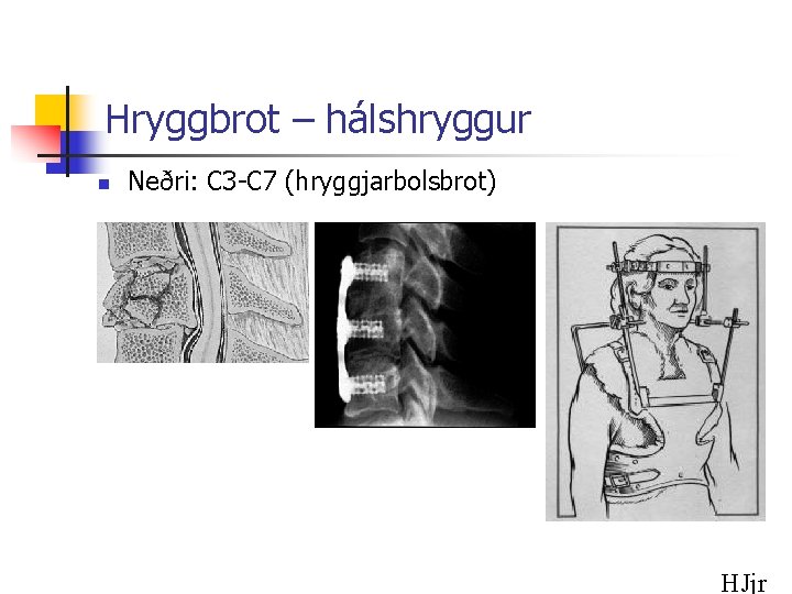 Hryggbrot – hálshryggur n Neðri: C 3 -C 7 (hryggjarbolsbrot) HJjr 