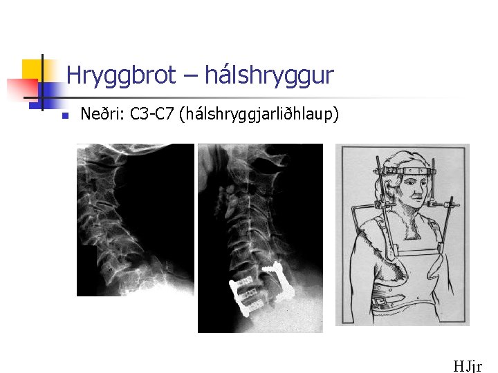Hryggbrot – hálshryggur n Neðri: C 3 -C 7 (hálshryggjarliðhlaup) HJjr 