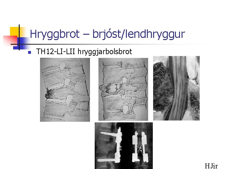 Hryggbrot – brjóst/lendhryggur n TH 12 -LI-LII hryggjarbolsbrot HJjr 