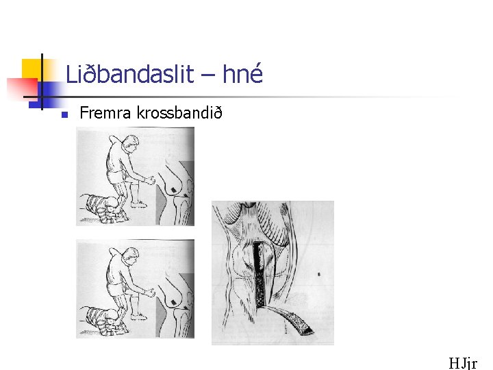 Liðbandaslit – hné n Fremra krossbandið HJjr 