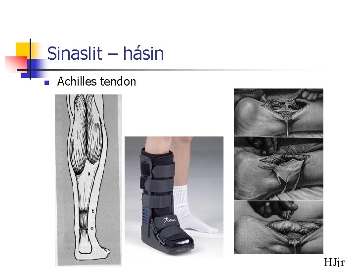 Sinaslit – hásin n Achilles tendon HJjr 