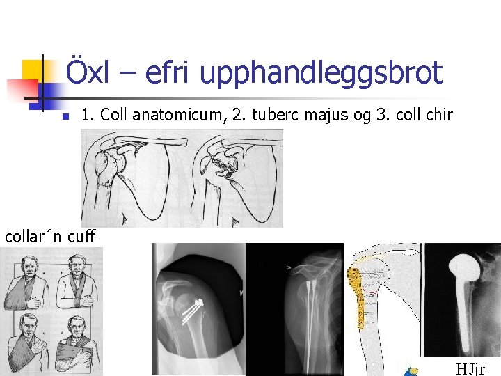 Öxl – efri upphandleggsbrot n 1. Coll anatomicum, 2. tuberc majus og 3. coll