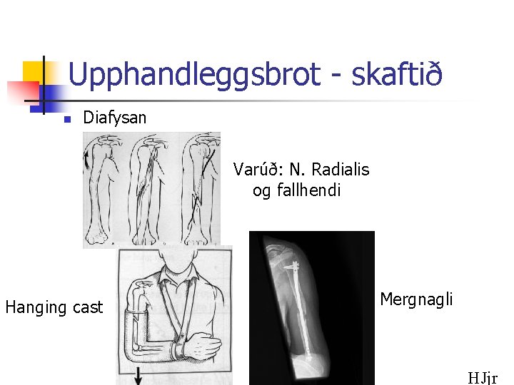 Upphandleggsbrot - skaftið n Diafysan Varúð: N. Radialis og fallhendi Hanging cast Mergnagli HJjr