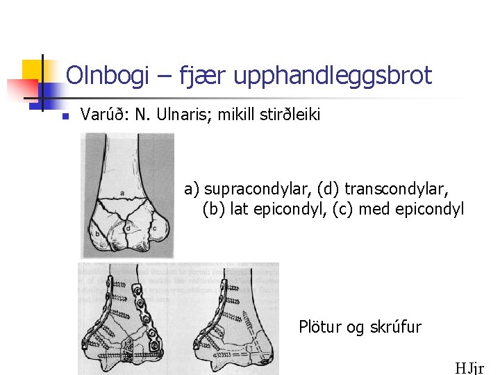 Olnbogi – fjær upphandleggsbrot n Varúð: N. Ulnaris; mikill stirðleiki a) supracondylar, (d) transcondylar,