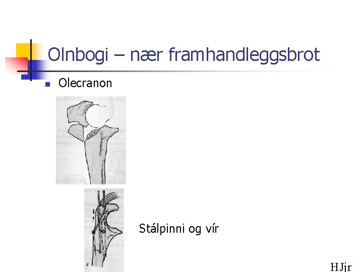 Olnbogi – nær framhandleggsbrot n Olecranon Stálpinni og vír HJjr 