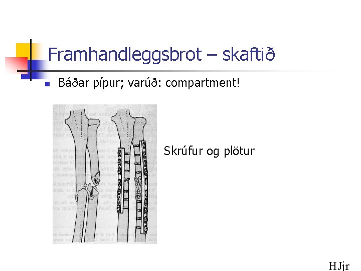 Framhandleggsbrot – skaftið n Báðar pípur; varúð: compartment! Skrúfur og plötur HJjr 