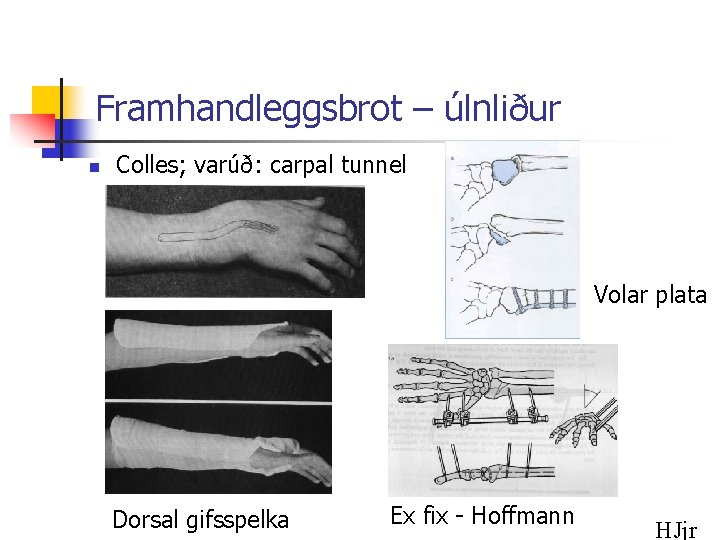 Framhandleggsbrot – úlnliður n Colles; varúð: carpal tunnel Volar plata Dorsal gifsspelka Ex fix