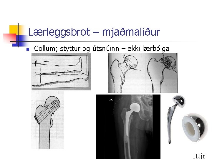 Lærleggsbrot – mjaðmaliður n Collum; styttur og útsnúinn – ekki lærbólga HJjr 