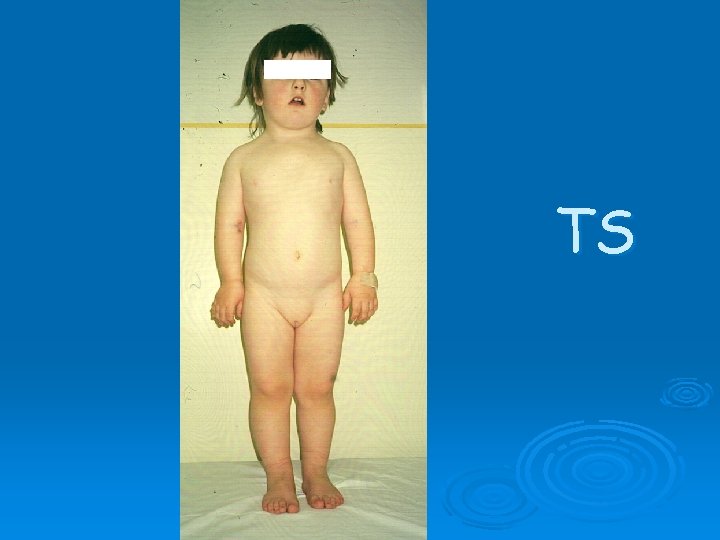 TS TS
