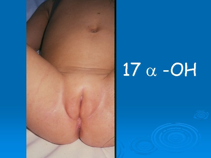 17 -OH 17 -OH