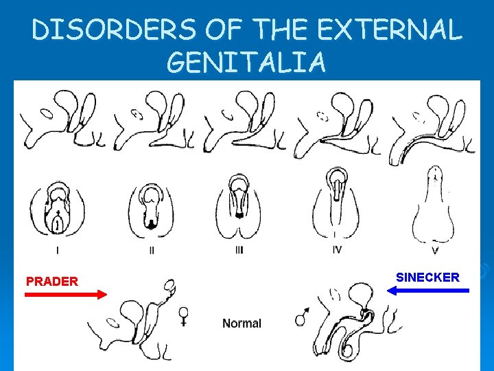DISORDERS OF THE EXTERNAL GENITALIA PRADER SINECKER DISORDERS OF THE EXTERNAL GENITALIA PRADER SINECKER