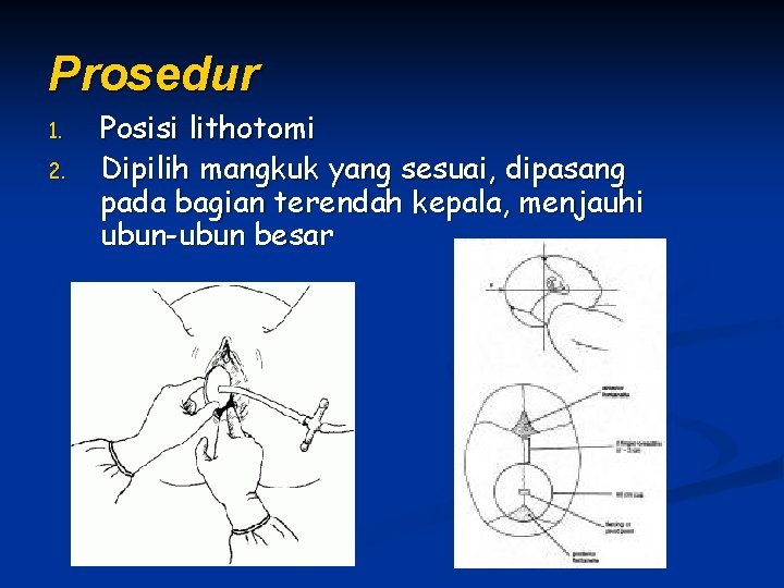 Prosedur 1. 2. Posisi lithotomi Dipilih mangkuk yang sesuai, dipasang pada bagian terendah kepala,