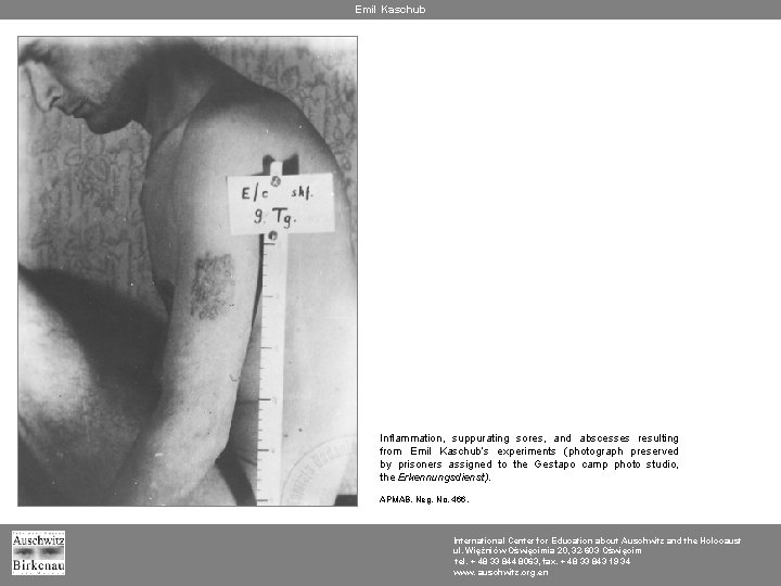 Emil Kaschub Inflammation, suppurating sores, and abscesses resulting from Emil Kaschub’s experiments (photograph preserved
