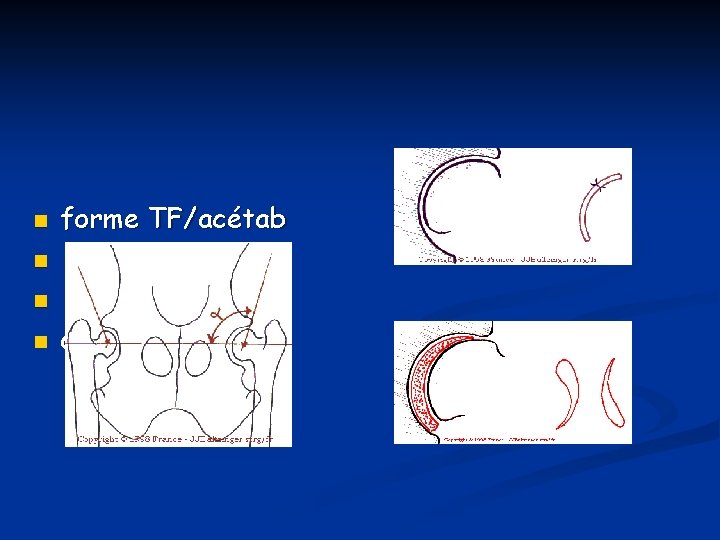 n n forme TF/acétab écart articulaire arthrose angle de N-O 