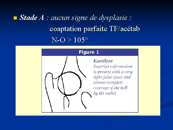 Stade A : aucun signe de dysplasie : coaptation parfaite TF/acétab N-O > 105°