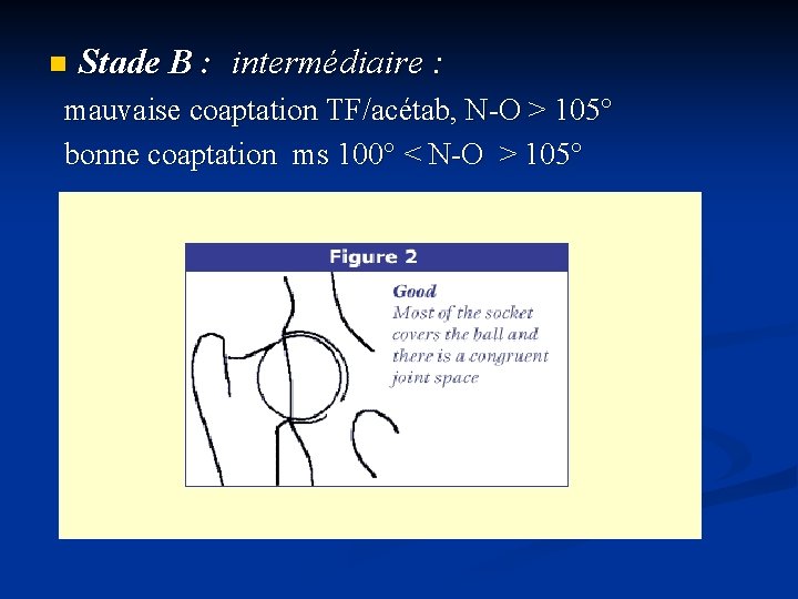 n Stade B : intermédiaire : mauvaise coaptation TF/acétab, N-O > 105° bonne coaptation