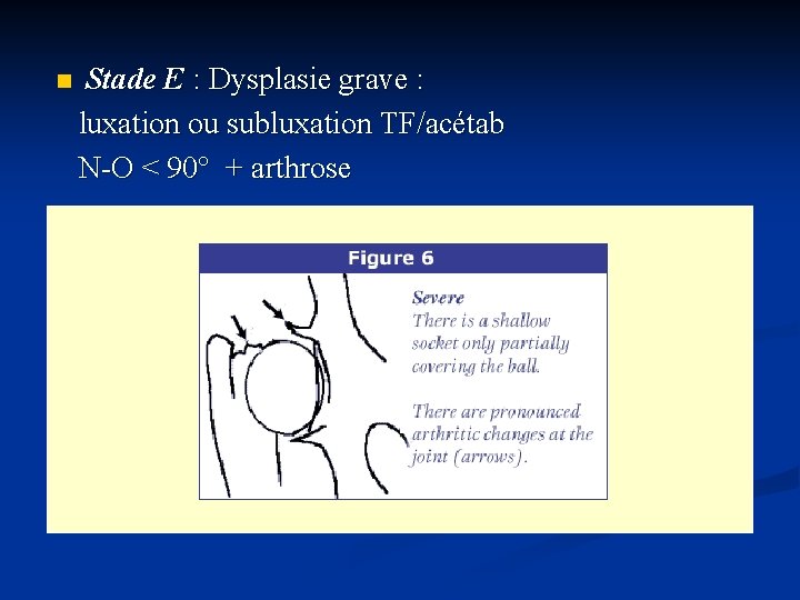 Stade E : Dysplasie grave : luxation ou subluxation TF/acétab N-O < 90° +