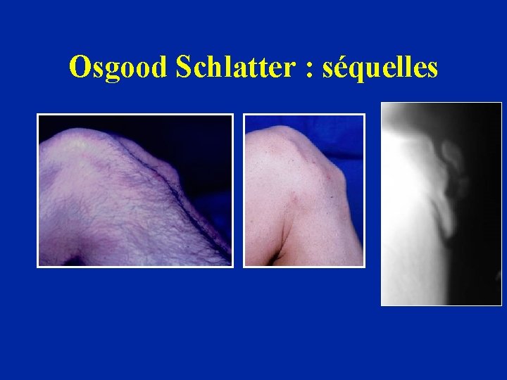 Osgood Schlatter : séquelles 