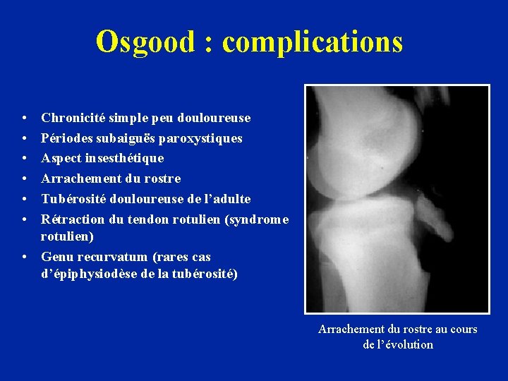 Osgood : complications • • • Chronicité simple peu douloureuse Périodes subaiguës paroxystiques Aspect