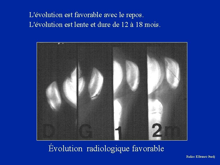 L'évolution est favorable avec le repos. L'évolution est lente et dure de 12 à