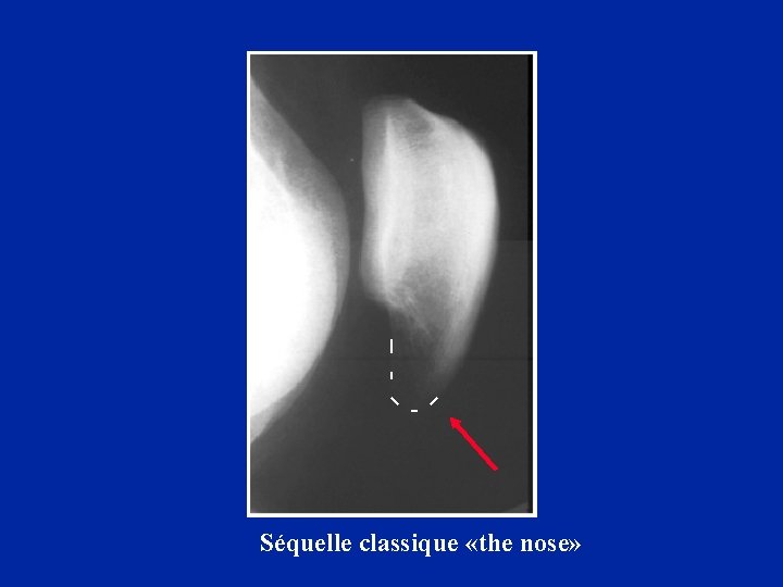 Séquelle classique «the nose» 