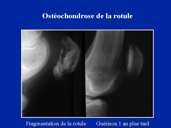 Ostéochondrose de la rotule Fragmentation de la rotule Guérison 1 an plus tard 