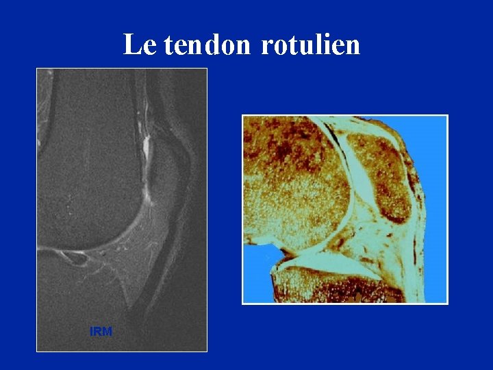 Le tendon rotulien IRM Anatomie 