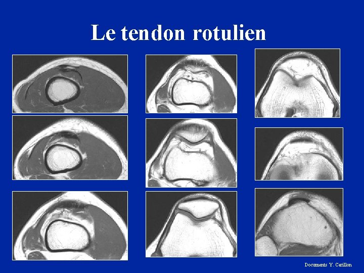 Le tendon rotulien Documents Y. Carillon 