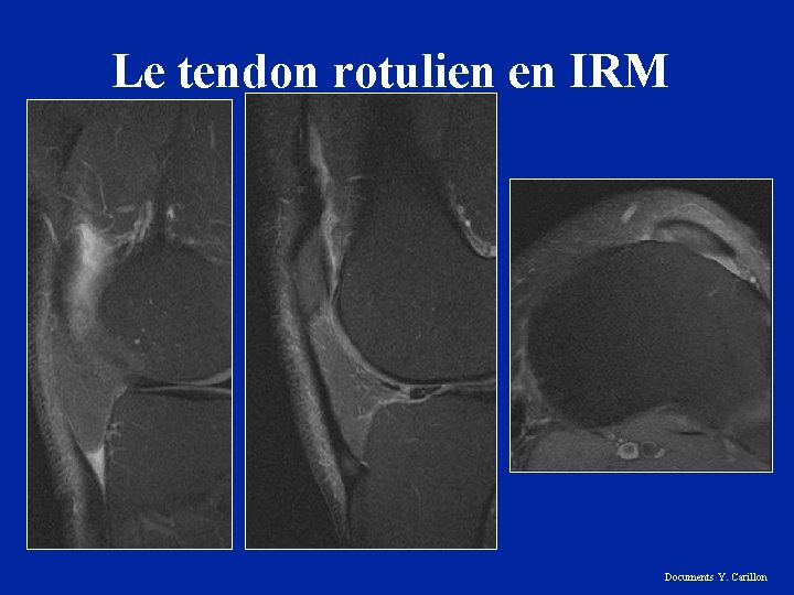 Le tendon rotulien en IRM Documents Y. Carillon 