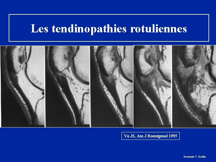 Les tendinopathies rotuliennes Yu JS, Am J Roentgenol 1995 Documents Y. Carillon 