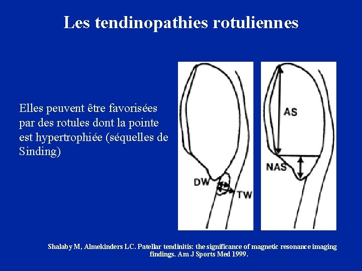 Les tendinopathies rotuliennes Elles peuvent être favorisées par des rotules dont la pointe est